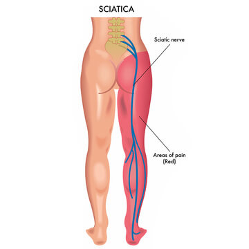SCIATIC NERVE PAIN