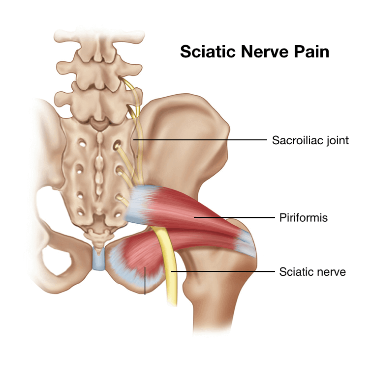 Sciatic Nerve Pain SI Piriformis square