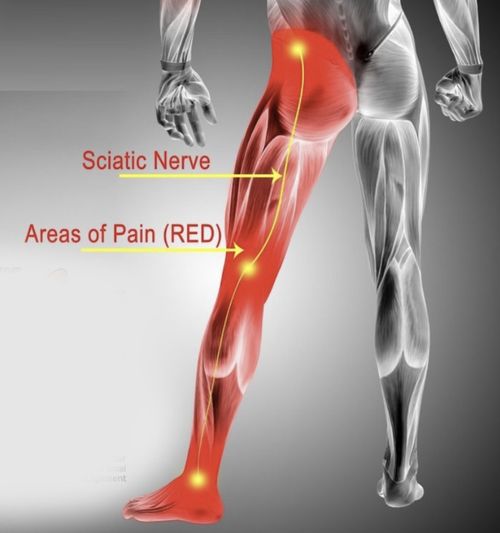 Sciatic20Pain