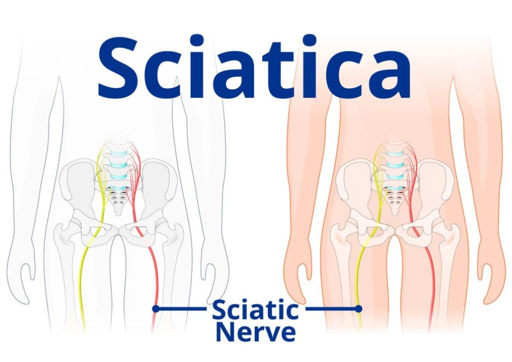 Sciatica Hip Pain Sciatica Back Pain Treatment 1030x729 1