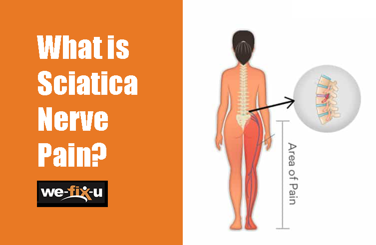 Sciatica nerve pain