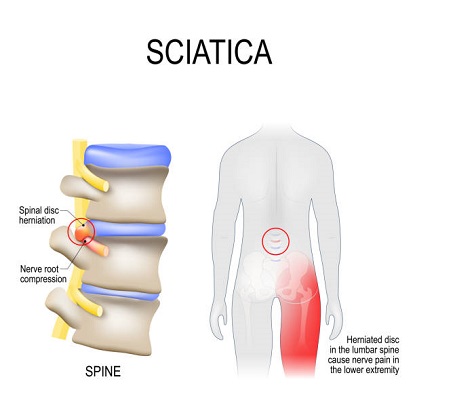 SciaticaPain 1