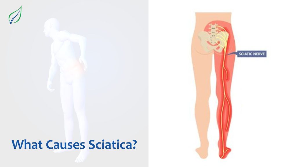 What20Causes20Sciatica 1703593852