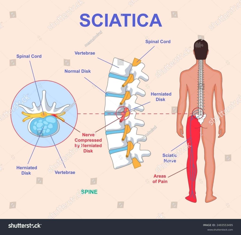 anatomical scheme with human spine nerves and intervertebral disc 2493553495