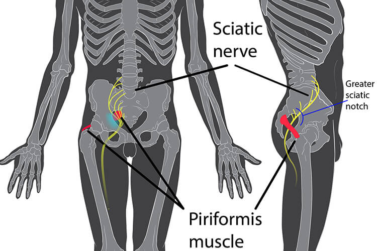 montreal Sciatic Nerve treatment