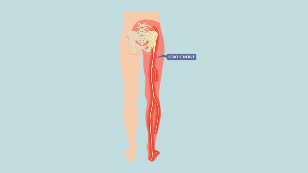 sciatic nerve header