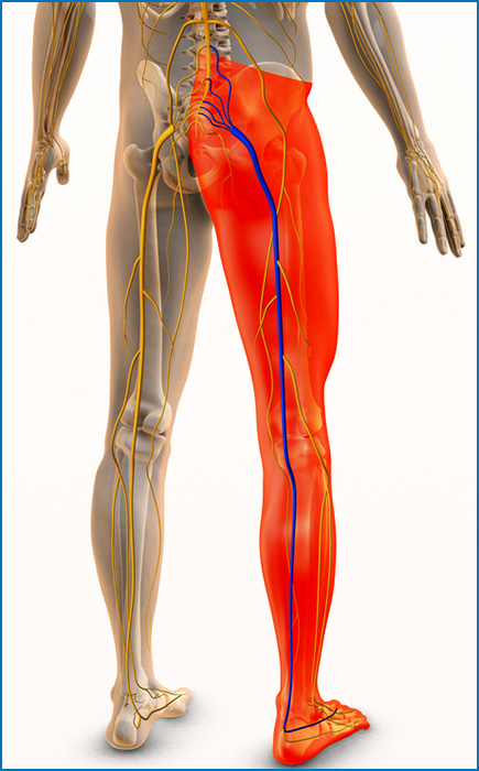 sciatic nerve pain illustration