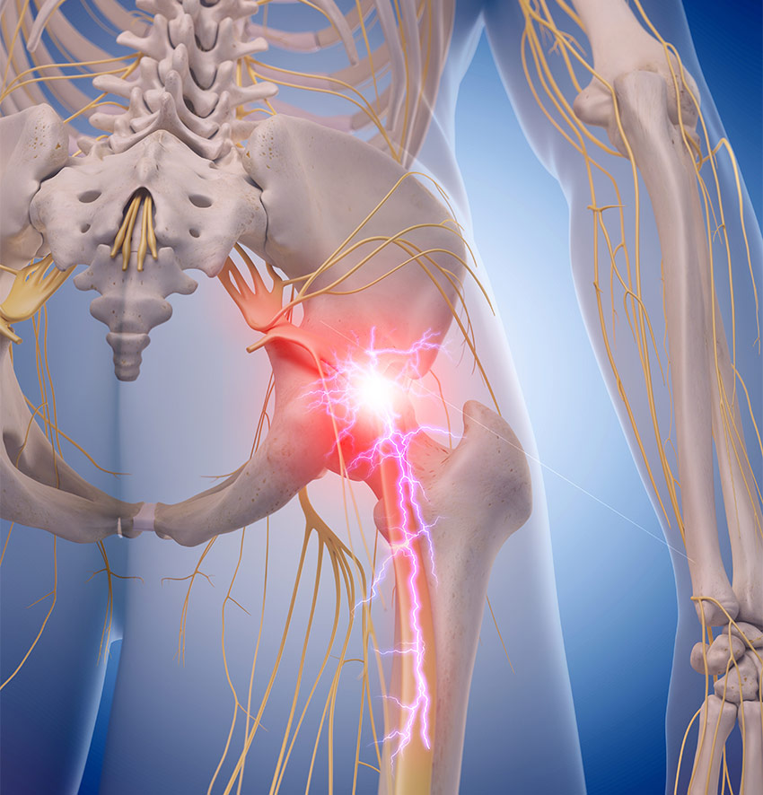sciatic nerve pain 850