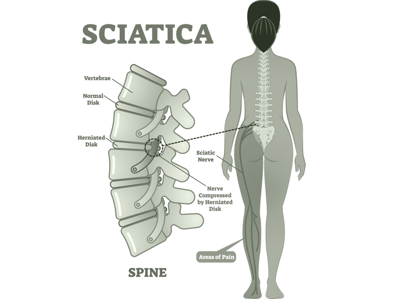 sciatica nerve pain