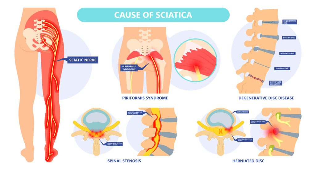 sciatica pain relief with chiropractic asfca olathe ks