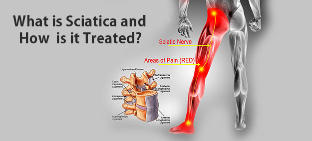 sciatica pain treatment