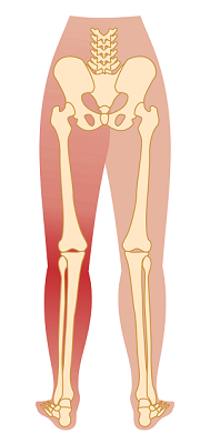 sciatica sciaitic pain Bodytonic clinic London