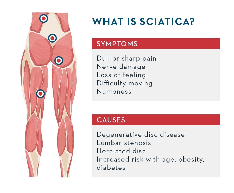 sciatica