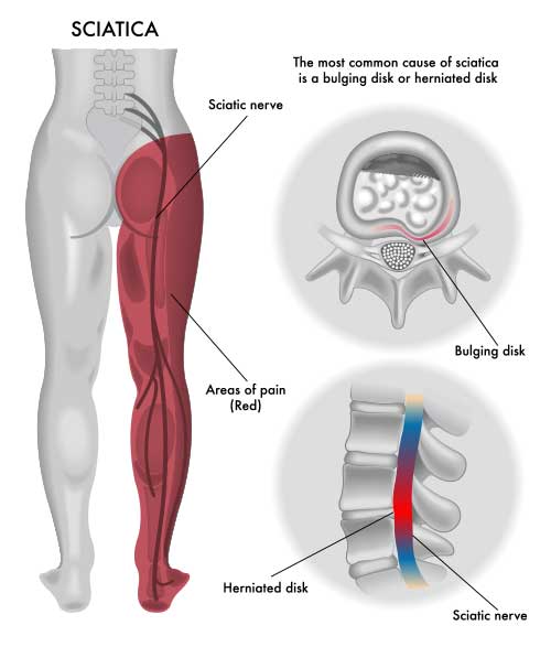 sciatica pain
