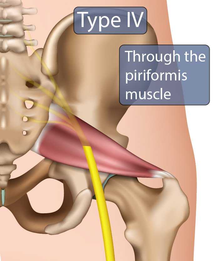 type iv sciatic nerve.jpg 706.0x831.0 q85 subject location 3532C414 subsampling 2